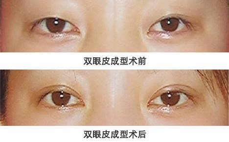 郑州双眼皮修复权威专家排行榜 郑州双眼皮修复最好的专家排名 郑州双眼皮修复最好的专家有哪些？