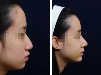 北京鼻修复好的专家有哪些？北京做鼻子修复最好的专家排名