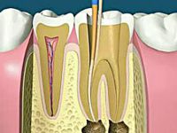 根管治疗就是抽牙神经吗？根管治疗和牙髓治疗是怎么回事？