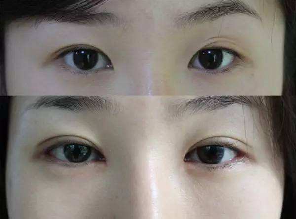 南京割双眼皮整形医生排行榜和技术特色