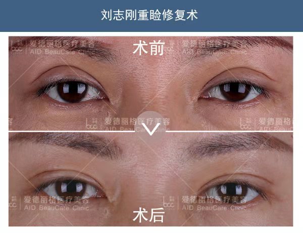 刘志刚双眼皮修复案例