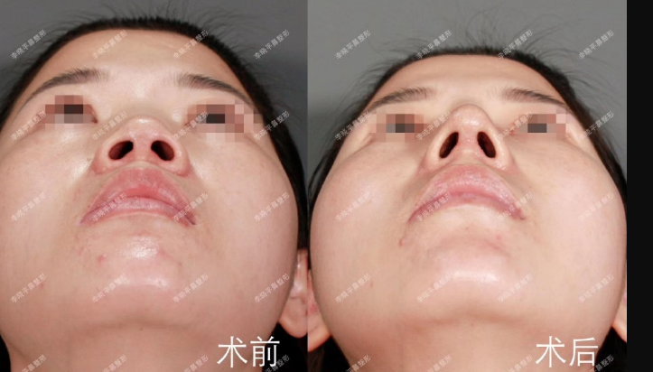 李晓平鼻修复案例