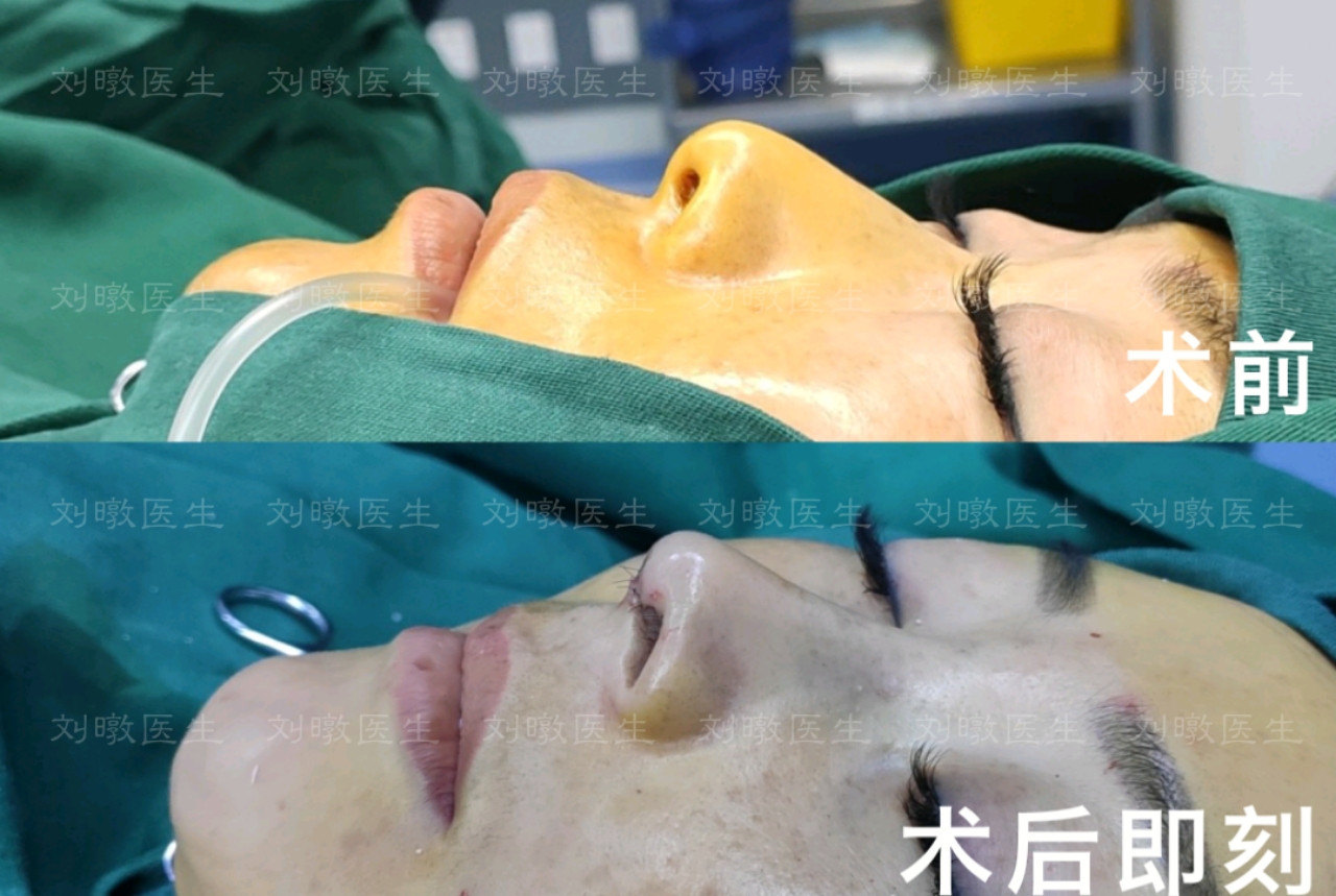 刘暾鼻子案例