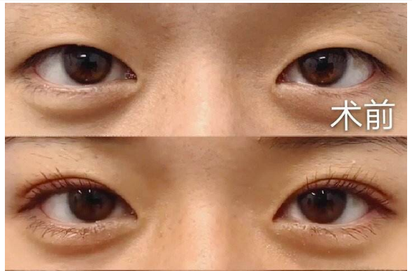 北京做双眼皮最好的专家是谁？