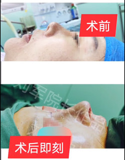 刘军鼻修复案例
