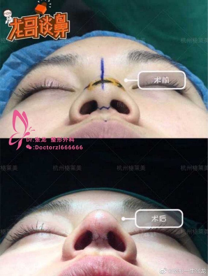 张龙鼻综合案例