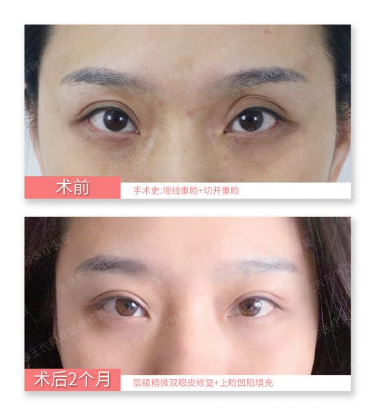 北京知名双眼皮修复专家是哪个？北京双眼皮修复专家名单