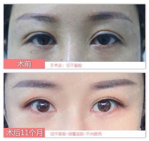 南京双眼皮修复哪个医生最好？