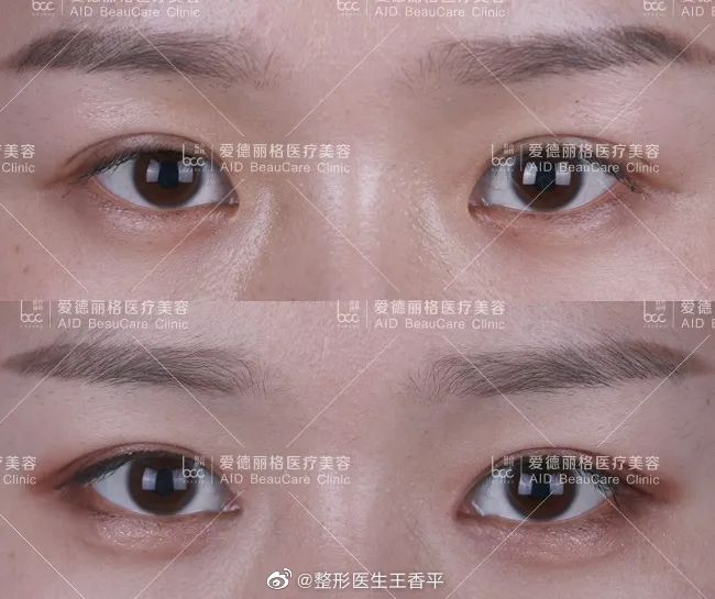 王香平双眼皮修复案例