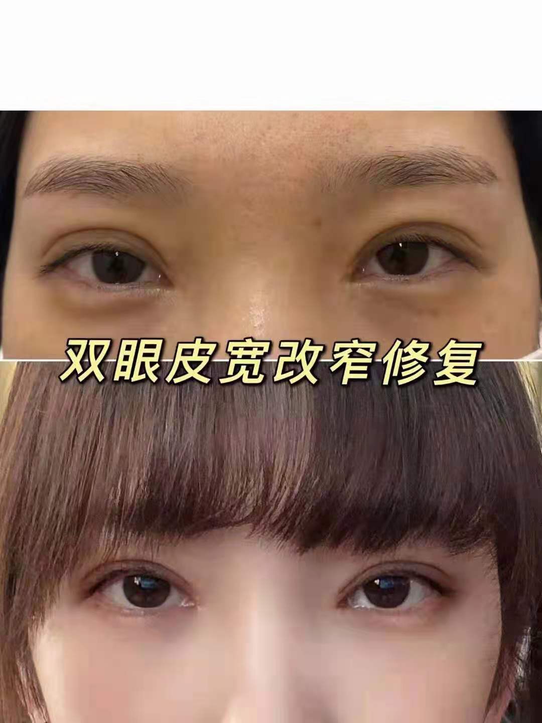 刘宁割双眼皮案例