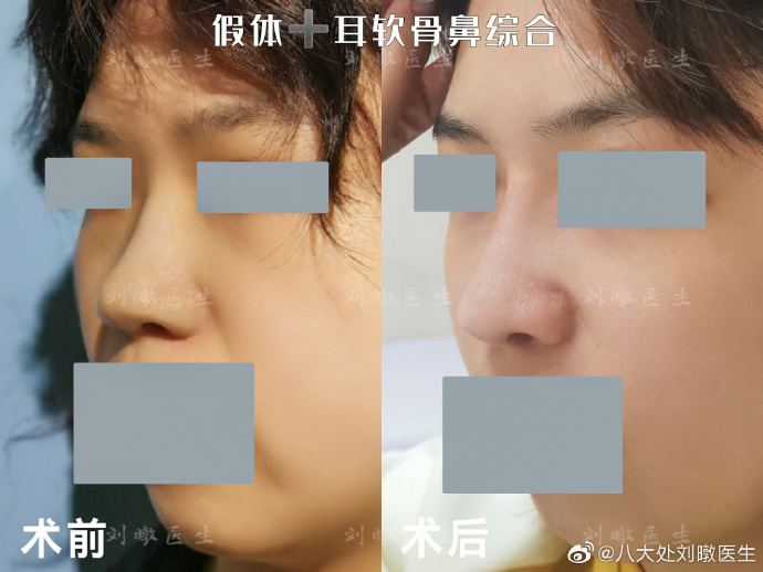 刘暾做鼻子案例