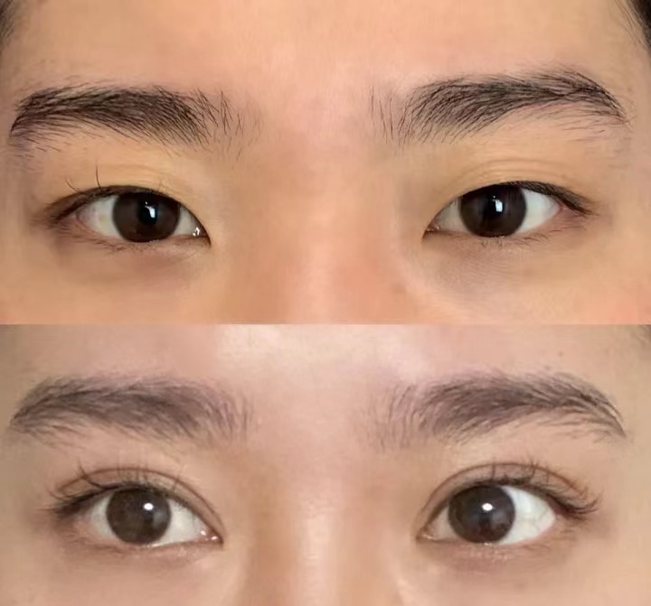 郑州双眼皮医生张丹阳做双眼皮技术怎么样？