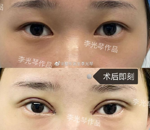 2024年广州双眼皮修复最好的医生有哪些？
