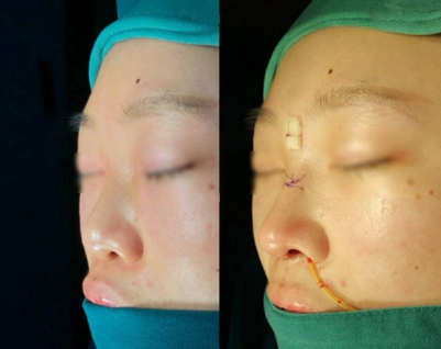 上海鼻修复案例