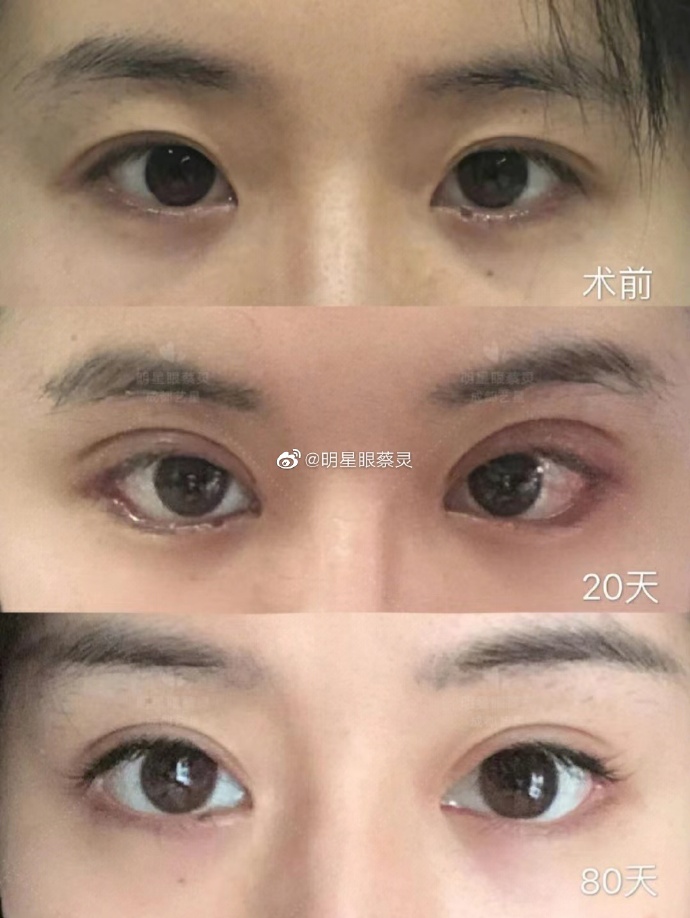 成都做双眼皮医生哪个最好？蔡灵、林威、杨迪、陈建华、林靖、刘海兰哪个最好？
