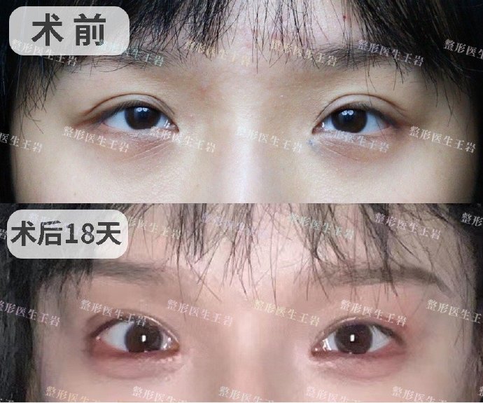 王岩双眼皮修复案例