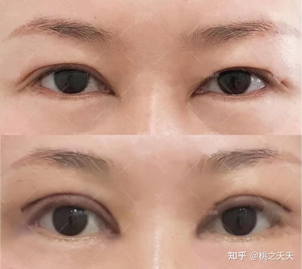 刘晓伟双眼皮修复案例