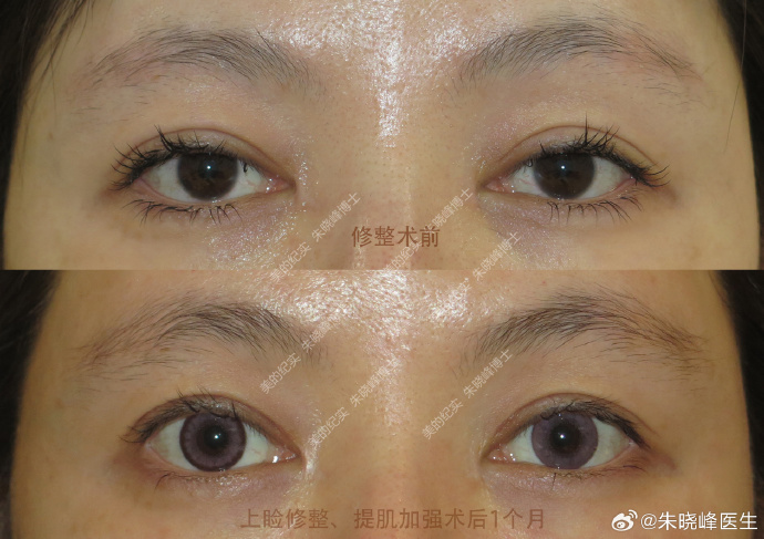 2024年北京双眼皮修复哪个医生好？朱晓峰、王维、韩勋、师丽丽、魏志香