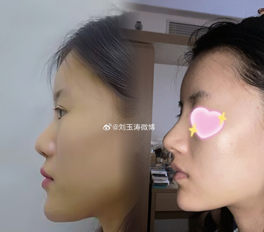 刘玉涛鼻修复案例