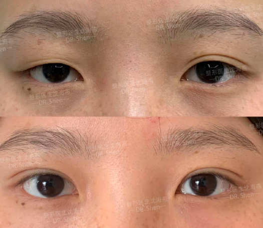 沈海燕_杭州市第一人民医院医疗美容科重睑修复双眼皮专家