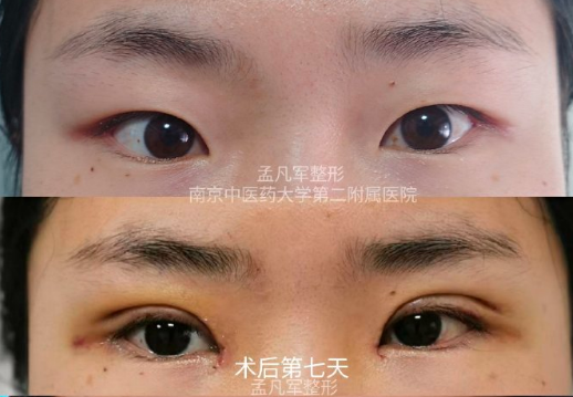 孟凡军_江苏省第二中医院整形外科双眼皮隆鼻整形专家