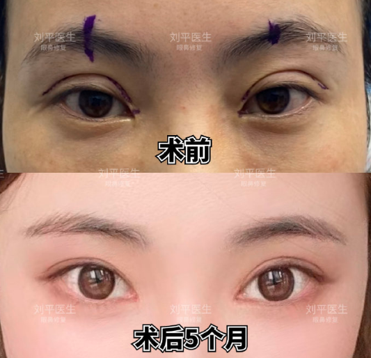 上海刘平修复双眼皮怎么样？技术好不好？