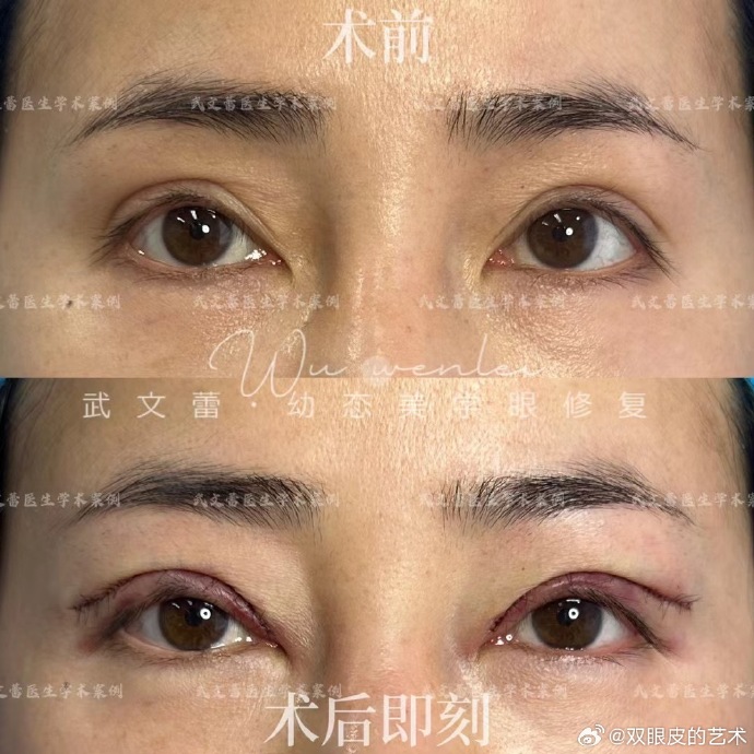 北京武文蕾修复双眼皮怎么样？
